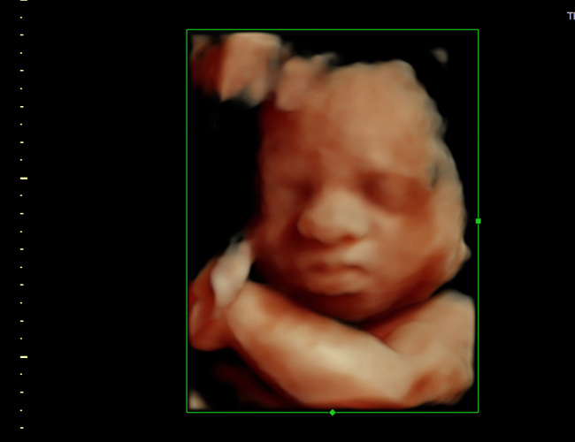 3D ultrasound image at 29 weeks